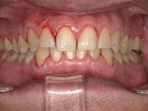 歯石を除去して歯間が正常化し、歯面が滑らかに改善した口腔内の状態。出血が軽減し清掃しやすくなった歯の写真。