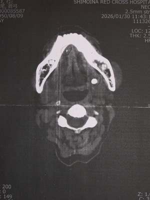 舌下部に丸い白い高吸収域が写るCT画像。唾石が2つ確認できる所見。唾石症
