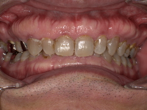 治療前の口腔写真。下顎後退により気道が狭くなっている様子