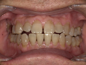 歯ぎしりによる歯の摩耗と知覚過敏症状を示す治療前の口腔写真