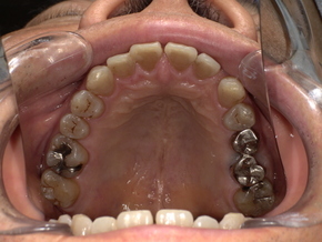 歯ぎしりによる歯の摩耗と知覚過敏症状を示す治療前の口腔写真