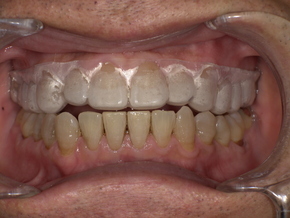 患者専用に作製したナイトガードを装着した口腔内写真。咬合負担を軽減するための保護装置