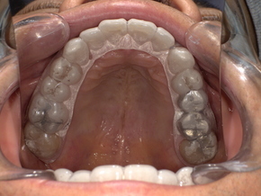 患者専用に作製したナイトガードを装着した口腔内写真。咬合負担を軽減するための保護装置
