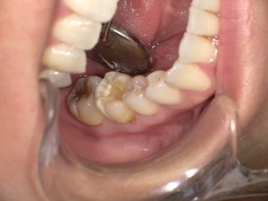 セラミック装着前