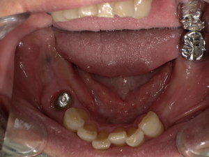 下奥歯に古い銀歯が装着され、歯と被せ物の境目に虫歯が再発している状態の口腔内写真」