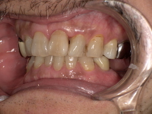 ジルコニアセラミッククラウンを装着し、自然な白さと透明感のある奥歯に改善された口腔内写真