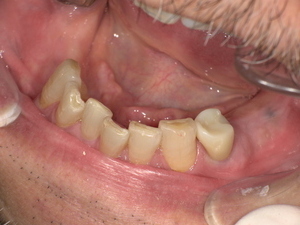 ジルコニアセラミッククラウンを装着し、自然な白さと透明感のある奥歯に改善された口腔内写真