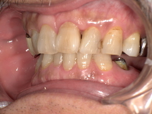 下奥歯に古い銀歯が装着され、歯と被せ物の境目に虫歯が再発している状態の口腔内写真