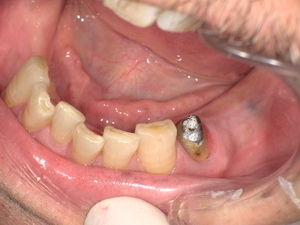 下奥歯に古い銀歯が装着され、歯と被せ物の境目に虫歯が再発している状態の口腔内写真