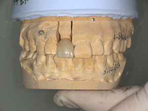 転倒で外れた前歯の被せ物をジルコニアセラミッククラウンで修復し、自然な色と形に改善した治療後の口腔内写真