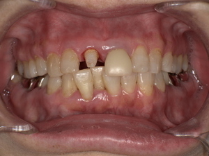 転倒の衝撃により上顎前歯の被せ物が外れた状態の口腔内写真