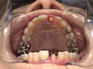 転倒の衝撃により上顎前歯の被せ物が外れた状態の口腔内写真