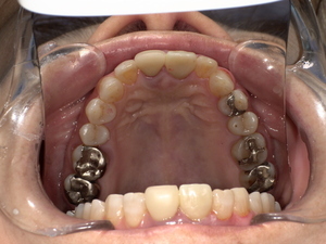 転倒で外れた前歯の被せ物をジルコニアセラミッククラウンで修復し、自然な色と形に改善した治療後の口腔内写真