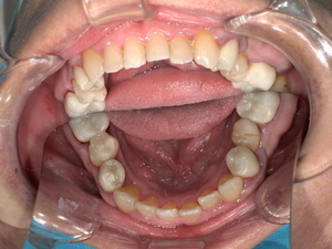 セラミックで修復され、天然歯のように自然な白さと透明感がある美しい歯の状態。
