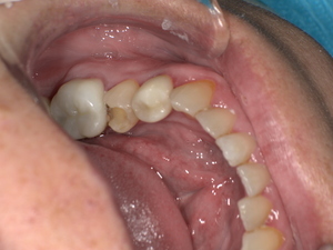 白い詰め物がとれた状態