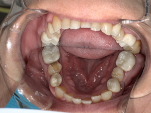 白い詰め物がとれた状態