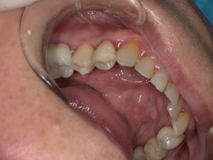 セラミックで修復され、天然歯のように自然な白さと透明感がある美しい歯の状態。