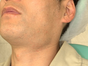 顎下腺の腫れ・ぷよぷよした膨らみ：唾液貯留