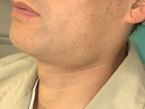 顎下腺の腫れ・ぷよぷよした膨らみ:唾液貯留