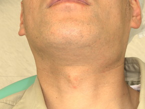 顎下腺の腫れ・ぷよぷよした膨らみ:唾液貯留