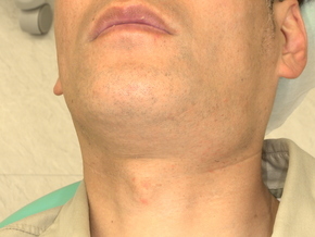 顎下腺の腫れ・ぷよぷよした膨らみ:唾液貯留