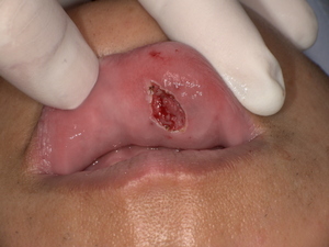 粘液嚢胞を切除した症例