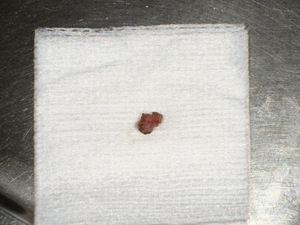 粘液嚢胞を切除した症例