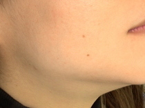 舌下腺・顎下腺の唾石症(だせきしょう)