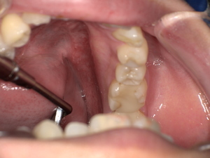 舌下腺・顎下腺の唾石症(だせきしょう)