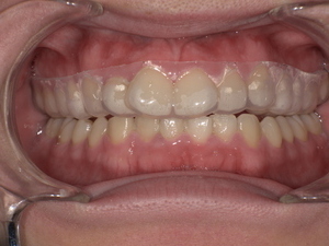 ナイトガード（歯ぎしり防止のマウスガード）