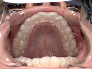 ナイトガード(歯ぎしり防止のマウスガード)