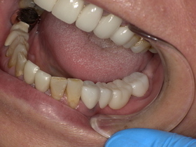 ジルコニアセラミック装着後。人工ダイヤモンド級の丈夫さで割れにくく、天然歯のような自然な白さを再現した奥歯の審美治療。