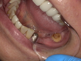 奥歯の銀歯が取れ、内部に二次虫歯が進行した状態。見た目の不調和だけでなく、歯を失うリスクがある治療前の症例写真。