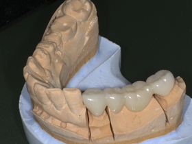 ジルコニアセラミック装着後。人工ダイヤモンド級の丈夫さで割れにくく、天然歯のような自然な白さを再現した奥歯の審美治療。