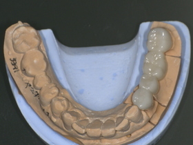 ジルコニアセラミック装着後。人工ダイヤモンド級の丈夫さで割れにくく、天然歯のような自然な白さを再現した奥歯の審美治療。