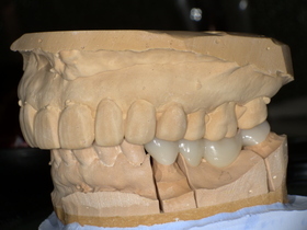 ジルコニアセラミック装着後。人工ダイヤモンド級の丈夫さで割れにくく、天然歯のような自然な白さを再現した奥歯の審美治療。