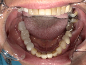 ジルコニアセラミック装着後。人工ダイヤモンド級の丈夫さで割れにくく、天然歯のような自然な白さを再現した奥歯の審美治療。