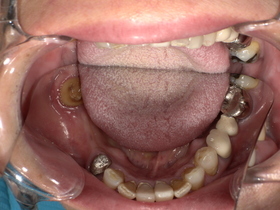 奥歯の銀歯が取れ、内部に二次虫歯が進行した状態。見た目の不調和だけでなく、歯を失うリスクがある治療前の症例写真。
