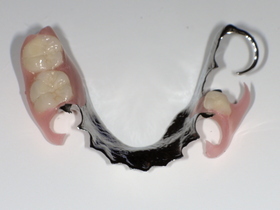 名古屋市天白区イナグマ歯科のノンクラスプデンチャーとチタン床義歯の症例写真