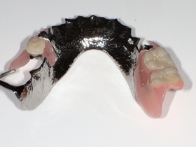 名古屋市天白区イナグマ歯科のノンクラスプデンチャーとチタン床義歯の症例写真