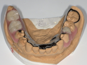 名古屋市天白区イナグマ歯科のノンクラスプデンチャーとチタン床義歯の症例写真