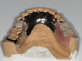 名古屋市天白区イナグマ歯科のノンクラスプデンチャーとチタン床義歯の症例写真