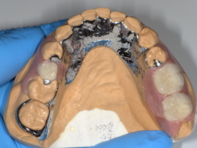 名古屋市天白区イナグマ歯科のノンクラスプデンチャーとチタン床義歯の症例写真