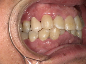 名古屋市天白区イナグマ歯科で行ったセラミック・ジルコニア治療後の口腔内写真」