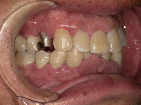 名古屋市天白区イナグマ歯科で撮影したセラミック・ジルコニア治療前の口腔内写真
