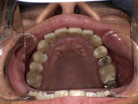 名古屋市天白区イナグマ歯科で行ったセラミック・ジルコニア治療後の口腔内写真」