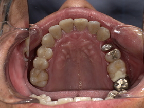 名古屋市天白区イナグマ歯科で撮影したセラミック・ジルコニア治療前の口腔内写真