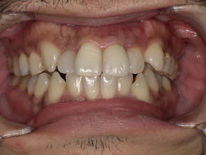 名古屋市天白区イナグマ歯科で行った前歯のセラミック治療症例。変色した前歯を自然な白さのセラミッククラウンで改善した様子