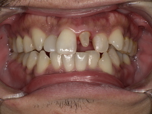 名古屋市天白区イナグマ歯科で行った前歯のセラミック治療症例。土台を入れたところ