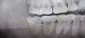 右親知らず抜歯前　Before